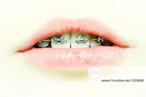 Teenager Mädchen Mund mit Zahnspange  extreme Nahaufnahme  Mund