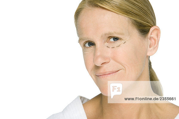 Woman with plastic surgery markings under one eye  smiling at camera