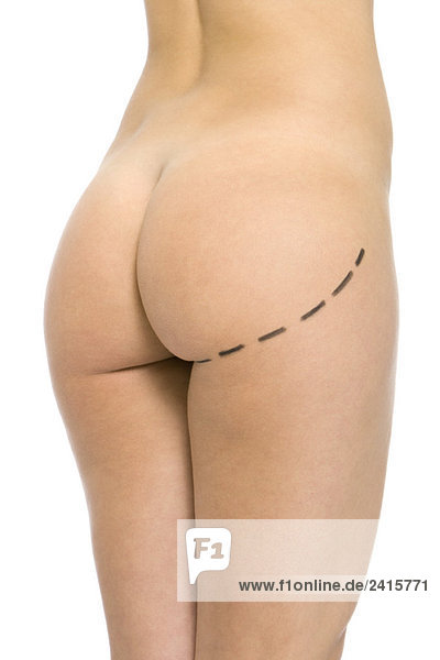 Nackte Frau mit plastischen Operationsmarkierungen am Gesäß  Schnittansicht