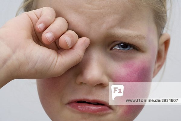 A little girl with a bruise on her cheek crying
