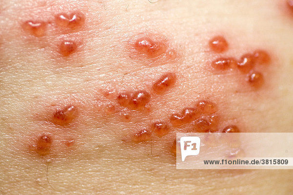 The illness Herpes Zoster  virus infection
