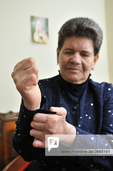 Lepra-Patientin  72 Jahre  mit verkrüppelten Händen schließt Knopf ihrer Bluse  Bogota  Kolumbien  Südamerika
