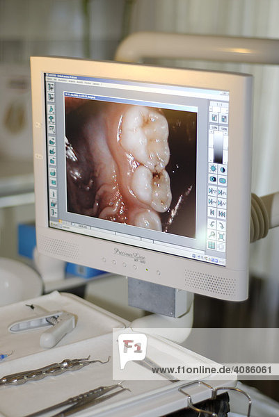 Beim Zahnarzt kariöser Zahn auf dem Bildschirm