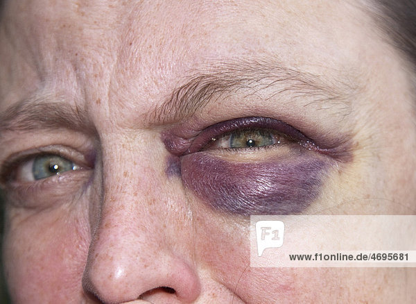 45jährige Frau mit blauem Auge,  Hämatom,  Bluterguss,  Blutung im Lidbereich des Auges,  Symbolbild für häusliche Gewalt
