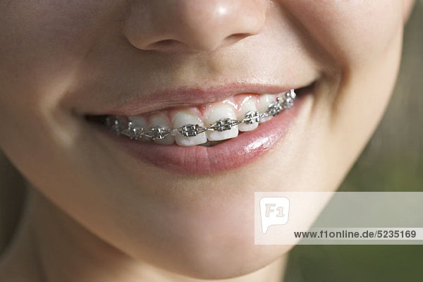 Ein lächelnder Teenager mit Zahnspange  ECU