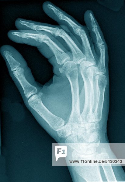 Röntgenbefunde einer chirurgischen Praxis . Das Röntgenbild zeigt : Hand ohne Befund