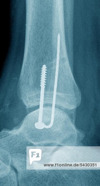Röntgenfoto einer chirurgischen Praxis . Das Röntgenbild zeigt :Verschraubter Innenknoechelbruch .