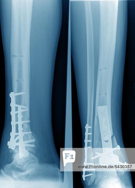 Röntgenfoto einer chirurgischen Praxis . Das Röntgenbild zeigt : Koerperferner Unterschenkelbruch mit Verplattung