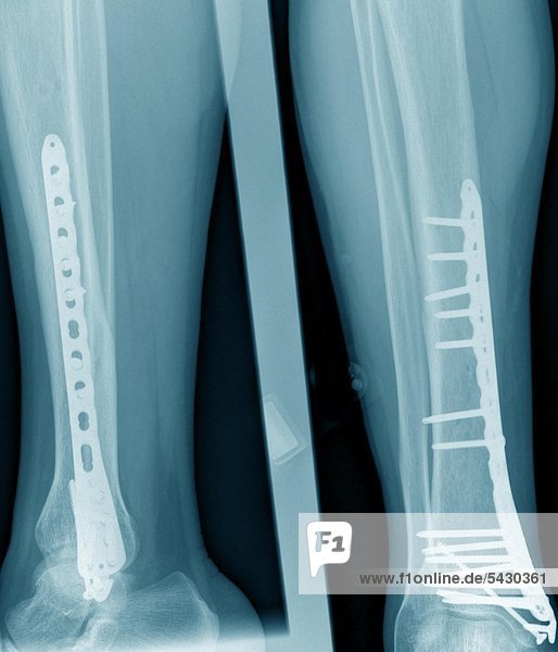 Röntgenfoto einer chirurgischen Praxis . Das Röntgenbild zeigt : Koerperferner Unterschenkelbruch mit Verplattung