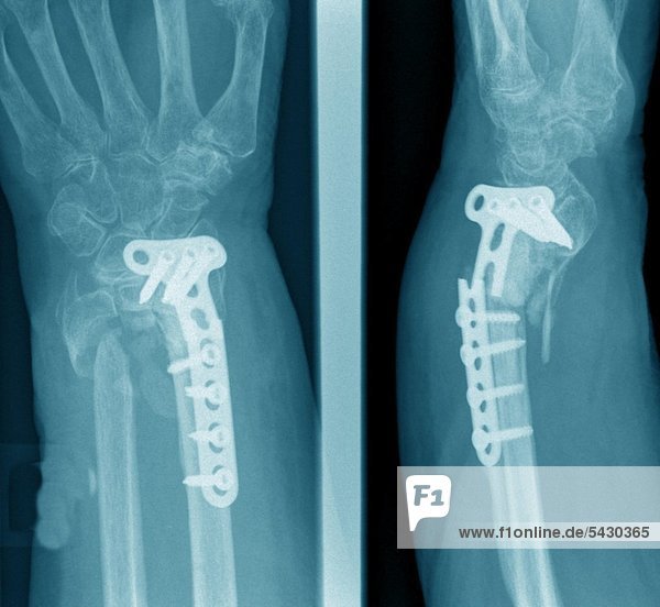 Röntgenfoto einer chirurgischen Praxis . Das Röntgenbild zeigt : Unterarmbruch mit Implantatversagen ( Plattenbruch )