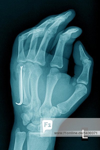 Röntgenfoto einer chirurgischen Praxis . Das Röntgenbild zeigt : Handbruch des Mittelhandknochens