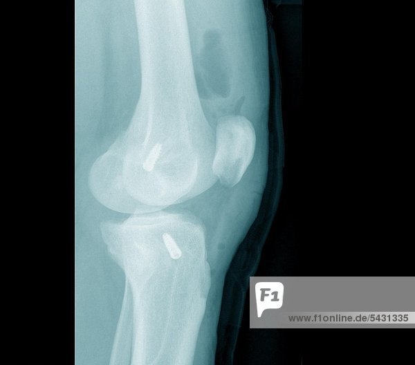 X-ray photographs of a surgical practice. Knee after operation of curciate ligament
