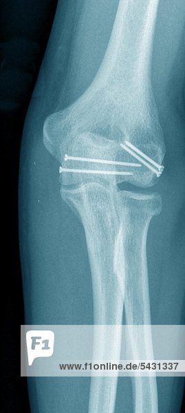 X-ray photographs of a surgical practice. fracture of the upper arm
