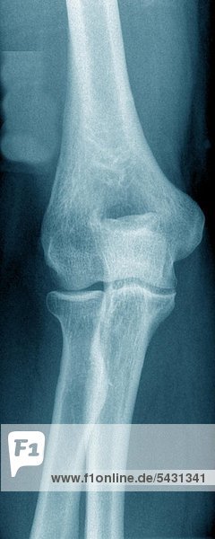 X-ray photographs of a surgical practice. elbow
