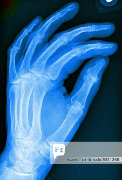 X-ray photographs of a surgical practice. Hand