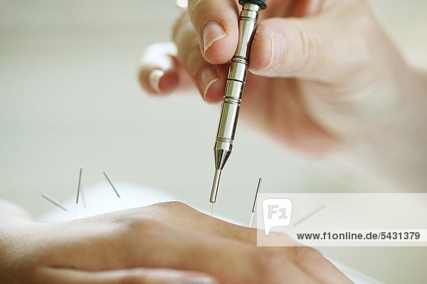 acupuncture -