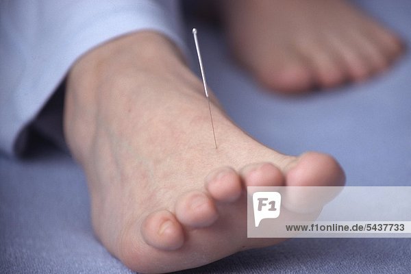 Akupunkturnadel am Fuß