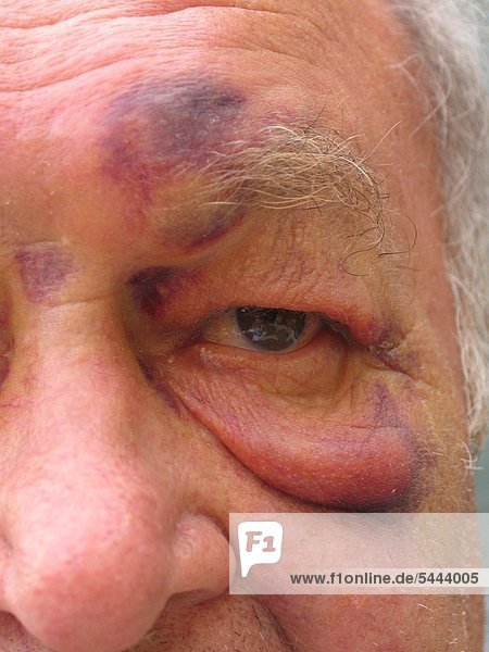 ein älterer Mann mit blauen Flecken im Gesicht nach einem Sturz im Wohnzimmer