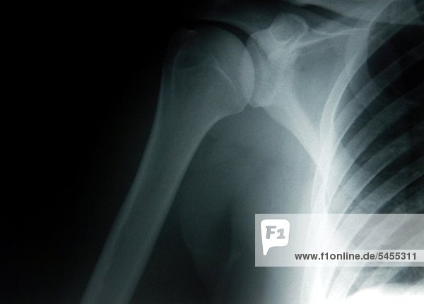Röntgenbild einer weiblichen Schulter