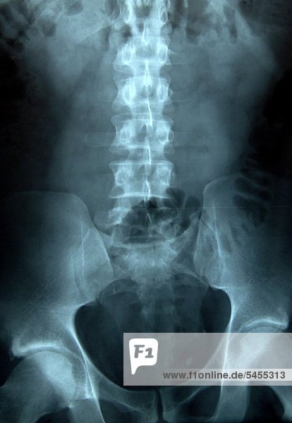 Röntgenbild eines weiblichen Lendenwirbels und Beckenknochens