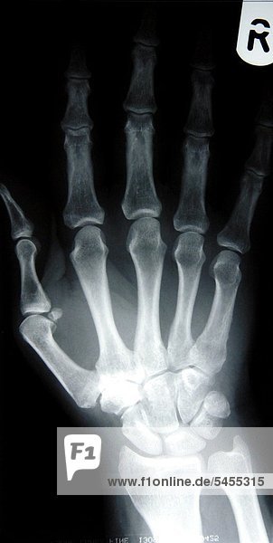 Röntgenbild einer weiblichen Hand