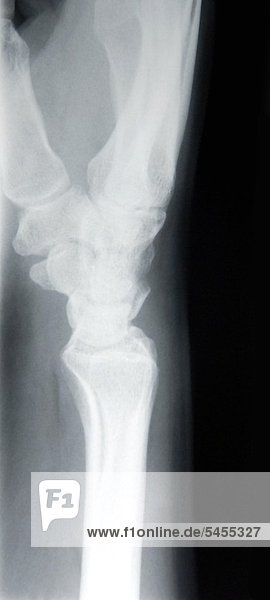 Röntgenbild eines weiblichen Handgelenks