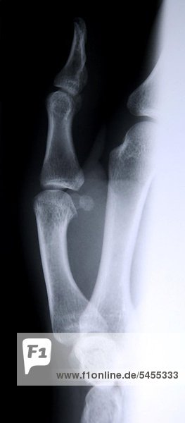 Röntgenbild eines Daumens