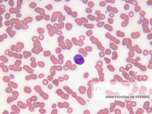 Close up of myeloische Leukämie-Zellen