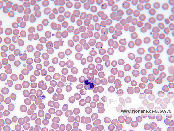 Malaria-Blutzellen