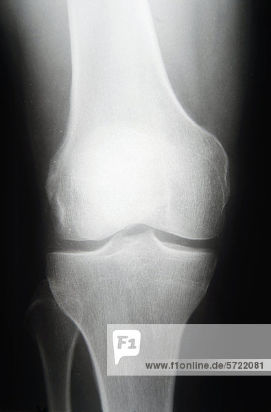 Röntgenaufnahme des Knies  Nahaufnahme