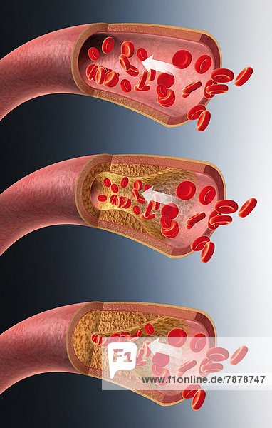 Arterie mit roten Blutkörperchen und Arteriosklerose