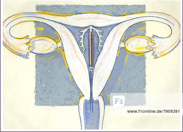 Intrauterinpessar in der Gebärmutter