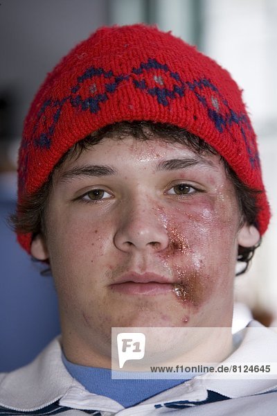 Accident Injury Teenager Boy One person Portrait Male Face Pain Ugly Beat-up Hurt Pain violence Looking at Camera Vertical Photography Cuts Bruises