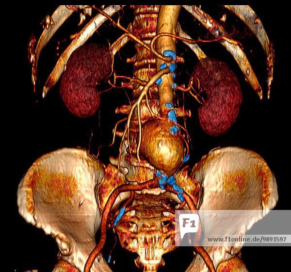 Dreidimensionale abdominale angiographische CT-Aufnahme mit einem großen abdominalen Aortenaneurysma (AAA). Auch Verkalkungen (blau eingefärbt) entlang der Aorta und ihrer Äste  die auf Atherosklerose hinweisen.
