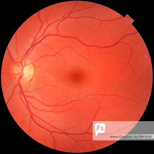 Fundusaufnahme eines normalen linken Auges. Makula in der Mitte und Sehnervenkopf  wo die Blutgefäße mit der Pigmentierung am Umfang zusammenlaufen.