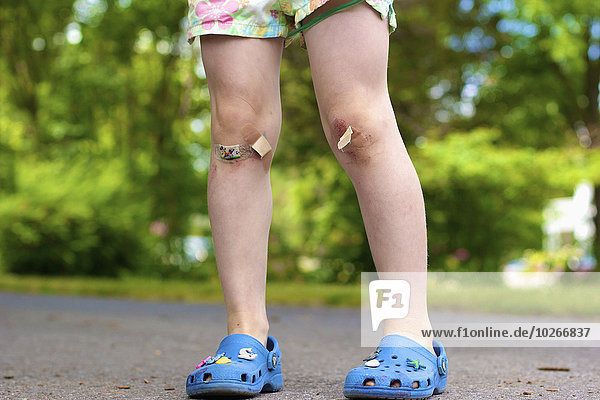 Girl with skinned knees and bandages; Picton  Ontario  Canada