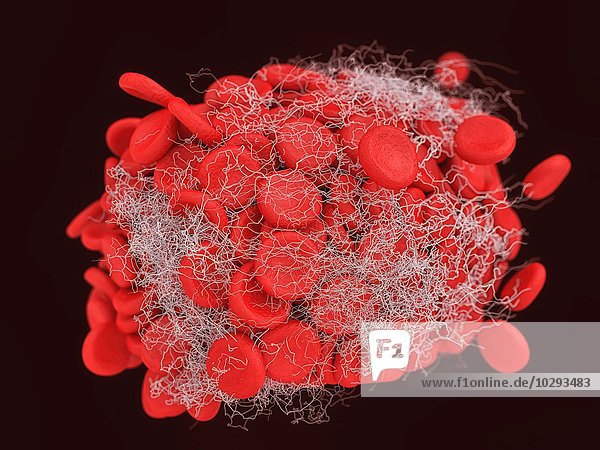 Abbildung eines Blutgerinnsels mit einem Klumpen roter Blutkörperchen in einem Fibrinnetz.