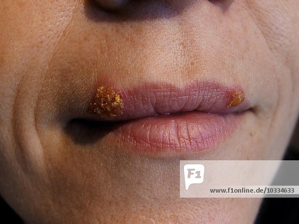 feminine mouth with herpes