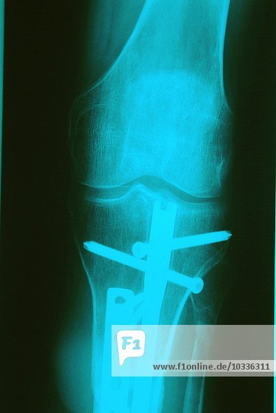 Röntgenplatte  Mehrfachfraktur mit Stiften nach Motorradunfall