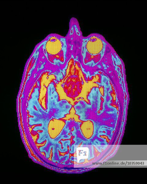 Farbige MRT-Gehirnuntersuchung: Hypophysenadenom