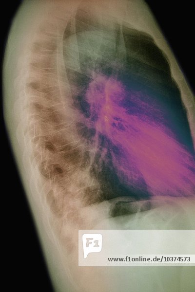 Seitliche Röntgenaufnahme der Lunge Unterlappenpneumonie
