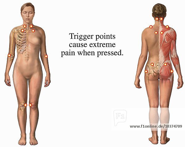 Dieses medizinische Exponat zeigt die Triggerpunkte auf  die mit dem Fibromyalgie-Syndrom (FMS) oder dem myofaszialen Schmerzsyndrom in Verbindung stehen. Die Druckpunkte sind auf zwei Ansichten der weiblichen Figur dargestellt  der vorderen (Vorderseite) und der hinteren (Rückseite).
