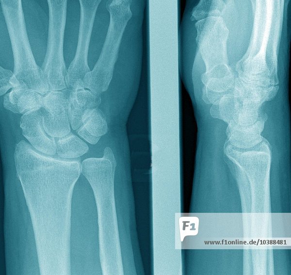 Röntgenaufnahme einer chirurgischen Praxis. Das Röntgenbild zeigt : Handgelenk o . B .