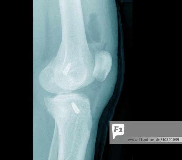 Röntgenaufnahmen aus einer chirurgischen Praxis. Knie nach Operation des Kreuzbandes