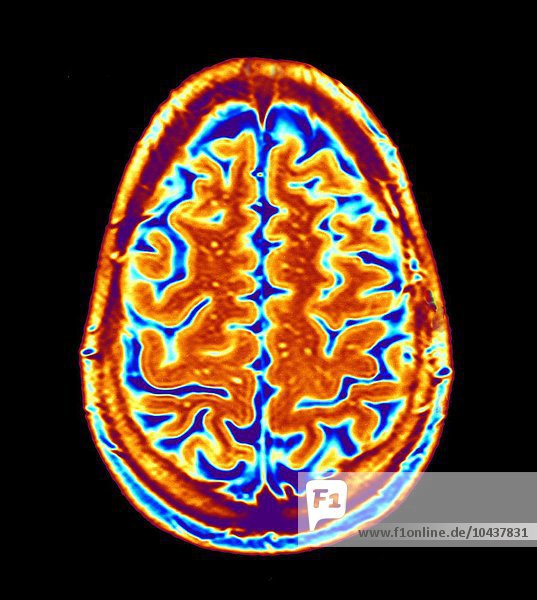 Normales Gehirn. Farbige Magnetresonanztomographie (MRT) eines axialen Schnitts durch ein gesundes Gehirn. Die Vorderseite des Gehirns befindet sich im oberen Teil des Bildes. Hier sieht man das Großhirn  den größten Teil des Gehirns. Es ist in zwei Gehirnhälften unterteilt und für bewusstes Denken  Emotionen und willkürliche Bewegungen verantwortlich. Gehirnscan  MRT-Scan