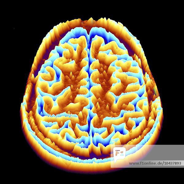 Normales Gehirn. Farbige Magnetresonanztomographie (MRT) eines axialen Schnitts durch ein gesundes Gehirn  umgewandelt in eine Höhenkarte oder ein Höhenfeld. Die Vorderseite des Gehirns befindet sich im oberen Teil des Bildes. Hier sieht man das Großhirn  den größten Teil des Gehirns. Es ist in zwei Gehirnhälften unterteilt und für bewusstes Denken  Emotionen und willkürliche Bewegungen verantwortlich. Gehirnscan  MRI-Scan  Höhenkarte
