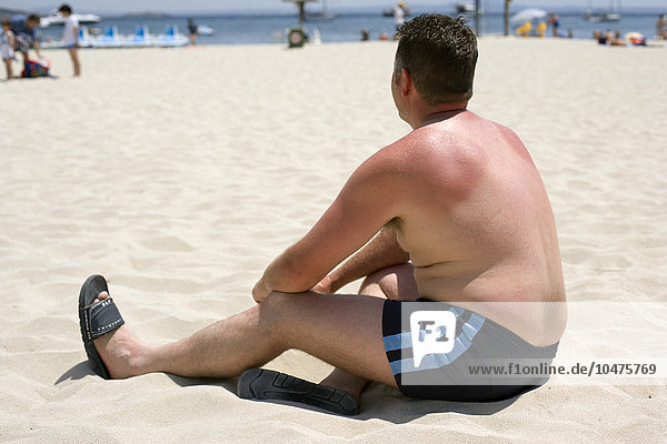 MODELL FREIGEGEBEN. Sonnenbrand. Mann mit sonnenverbrannten Schultern am Strand sitzend. Sonnenbrand wird durch übermäßige Sonneneinstrahlung verursacht. Die ultraviolette Strahlung des Sonnenlichts zerstört die Zellen der äußeren Hautschicht und schädigt die winzigen Blutgefäße darunter. Die betroffene Haut entzündet sich und kann Blasen werfen. Einige Tage später schälen sich die abgestorbenen Zellen ab. Sonnenbrand tritt am häufigsten bei hellhäutigen Menschen auf  deren Haut das schützende Pigment Melanin fehlt. Wiederholte Sonnenbestrahlung kann die Haut vorzeitig altern lassen und erhöht das Risiko von Hautkrebs. Galmei-Lotion und Schmerzmittel können helfen  einen Sonnenbrand zu lindern  aber in schweren Fällen ist ärztliche Hilfe und die Verabreichung von Kortikosteroiden erforderlich. Sonnenbrand