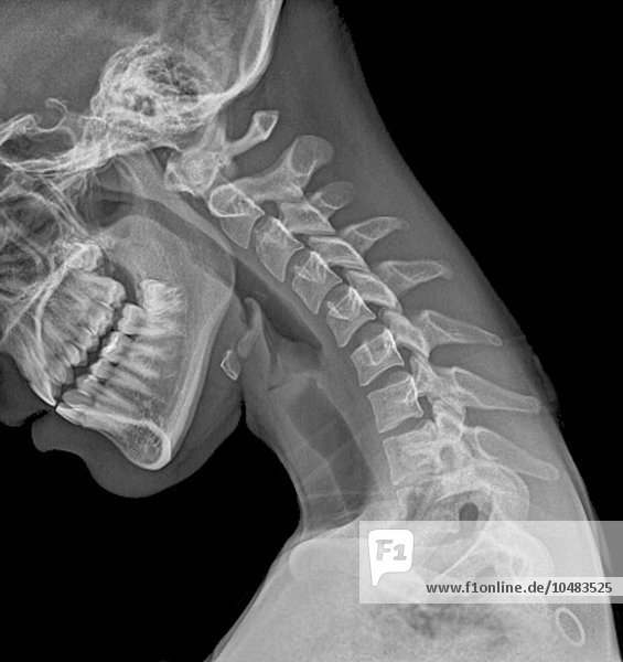 Normal gebeugter Nacken. Röntgenbild der gebeugten Halswirbelsäule einer 20-jährigen Frau  normaler gebeugter Hals  Röntgenbild