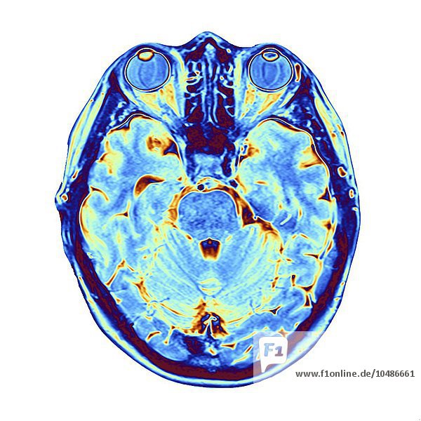 Gehirn-Scan. Falschfarben-Magnetresonanztomographie (MRT) eines menschlichen Kopfes mit einem gesunden Gehirn in horizontaler Ansicht. Im oberen Rahmen sind die beiden Augäpfel zu sehen. Zwischen den Augen befindet sich die Nasenhöhle mit den Nasenmuscheln  dünnen  spiralförmigen Knochen. Das MRT-Scannen ist eine Diagnosetechnik  bei der ein starker Elektromagnet und Radiowellen Querschnittsbilder von Körperregionen erzeugen. MRT-Gehirnscan
