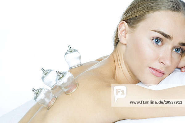 woman receiving cupping acupuncture